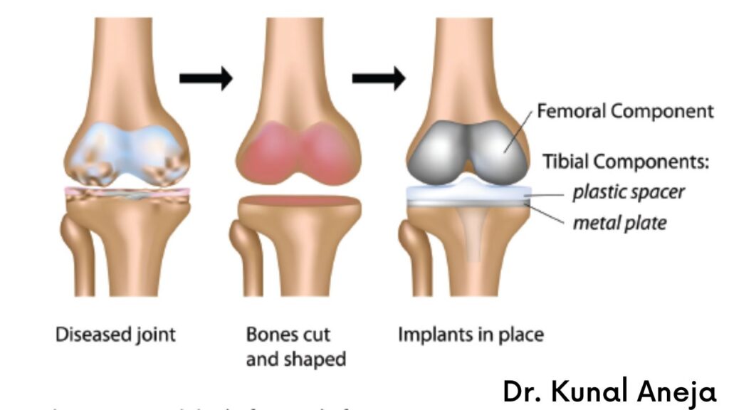 Best Hip Replacement Surgery In Rohini