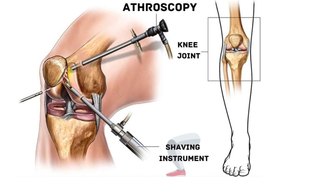 Knee Arthroscopy in Rohini