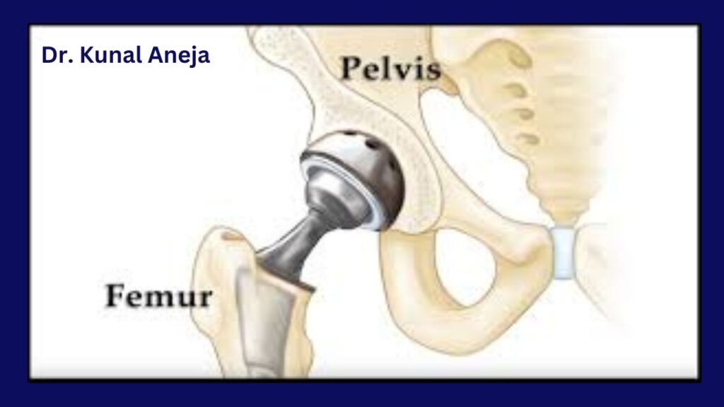 Total hip Replacement in Delhi- Dr Kunal Aneja