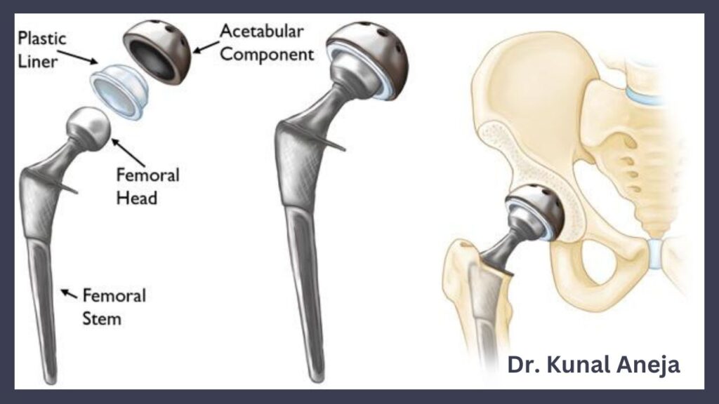 Best Hip Replacement Surgeon in Delhi