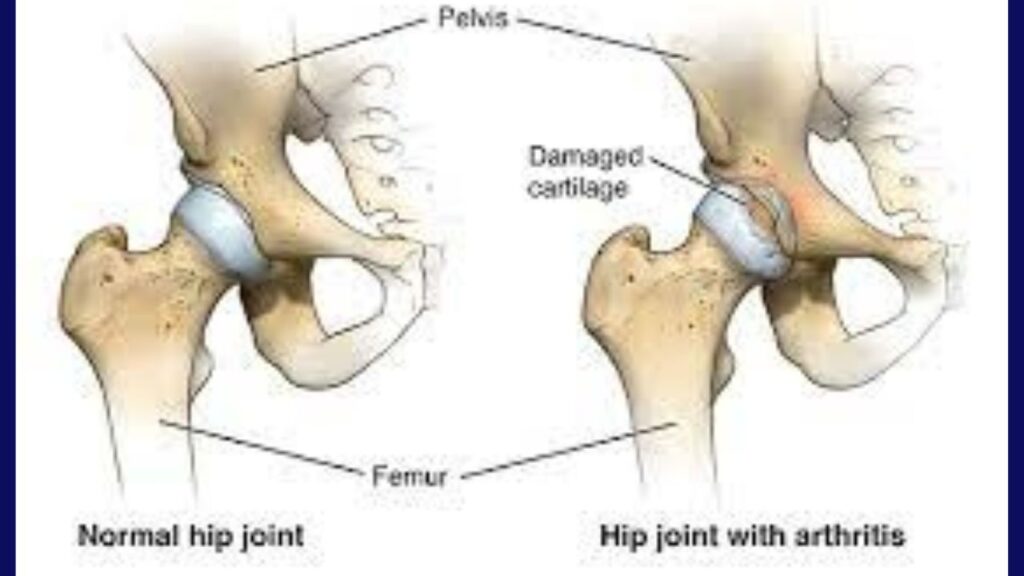 Hip Replacement Surgeon in Delhi