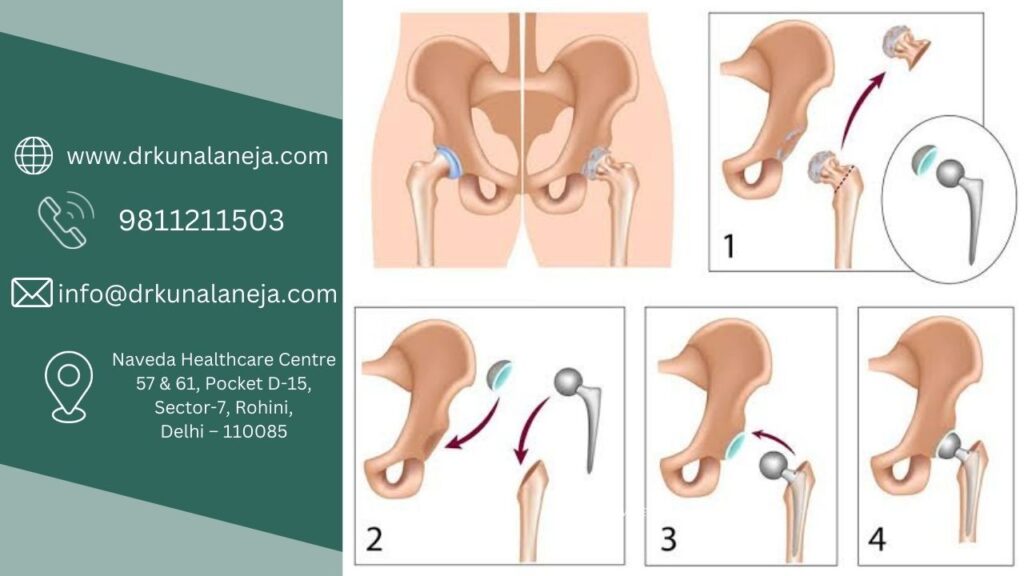 Hip Replacement In Rohini