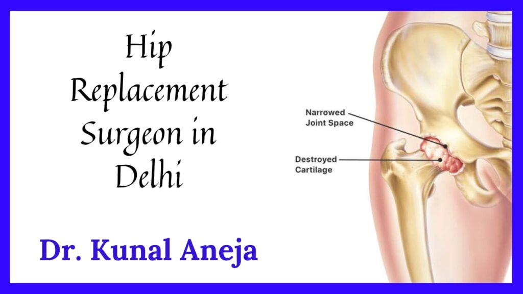 Hip Replacement Surgeon in Delhi