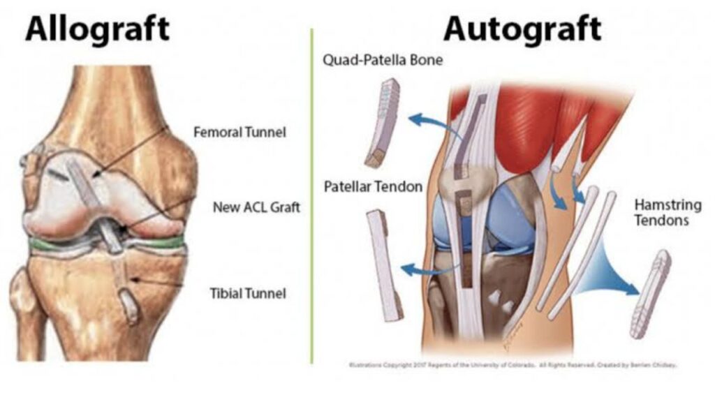 Knee Replacement Surgeon