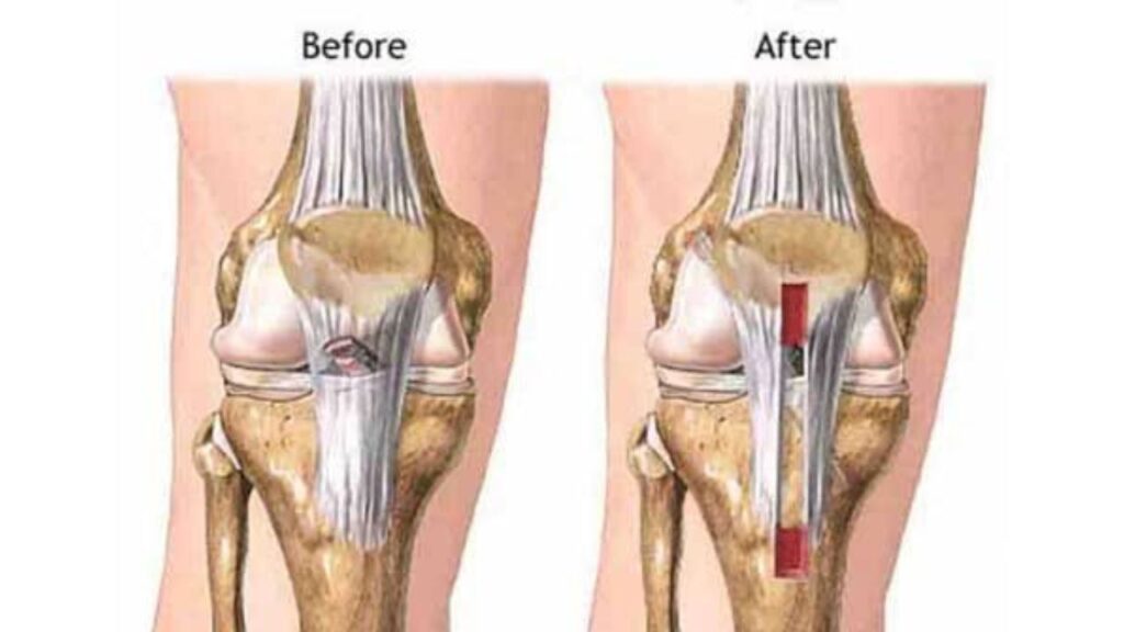 knee replacement surgery