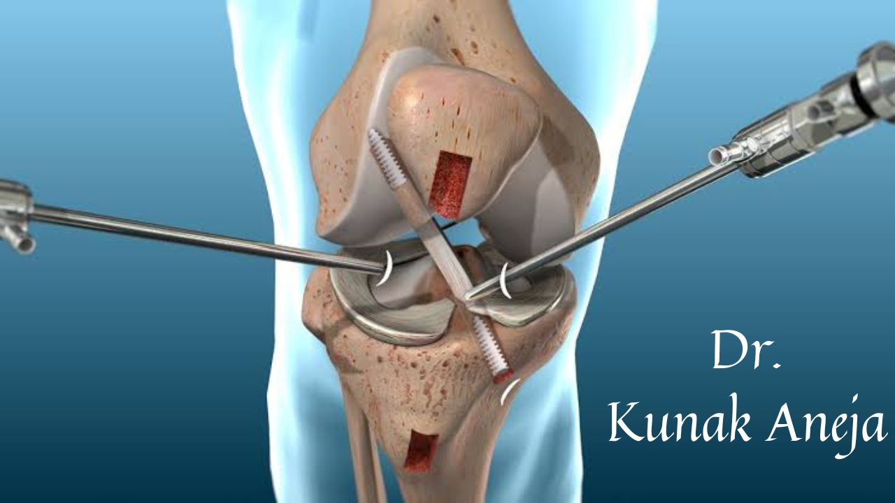 Best Knee Arthroscopy Doctor In Rohini