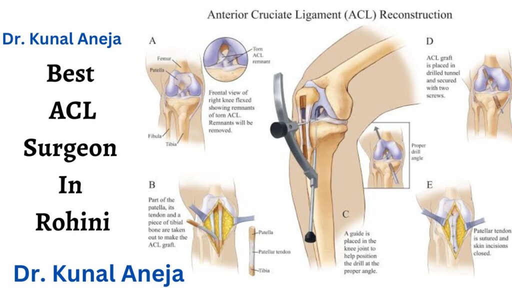 ACL Surgery in Delhi