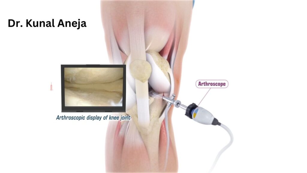 knee replacement 