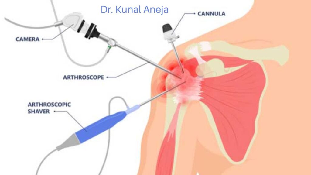 Shoulder Arthroscopy Surgery in Delhi