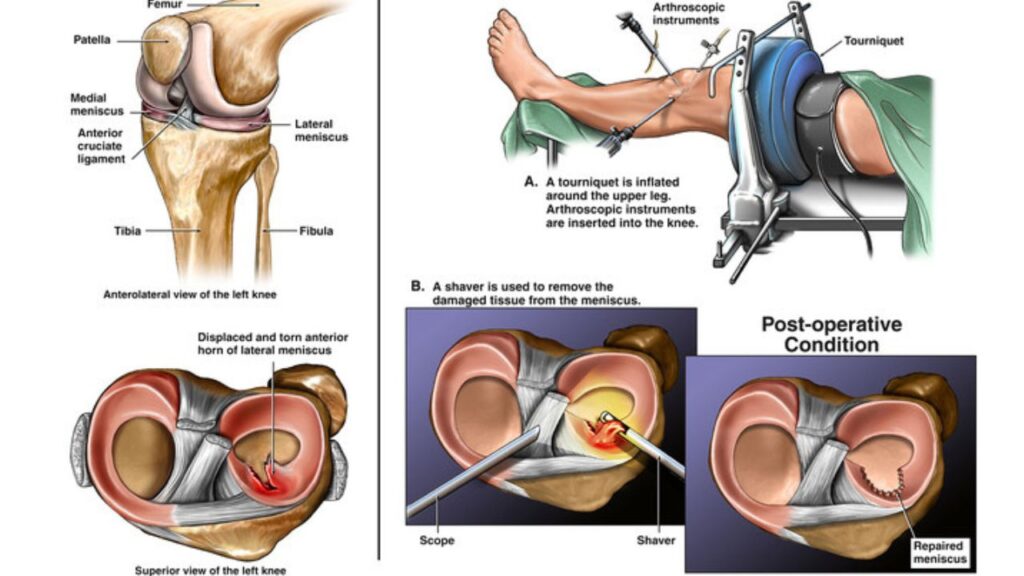 Meniscus Treatment