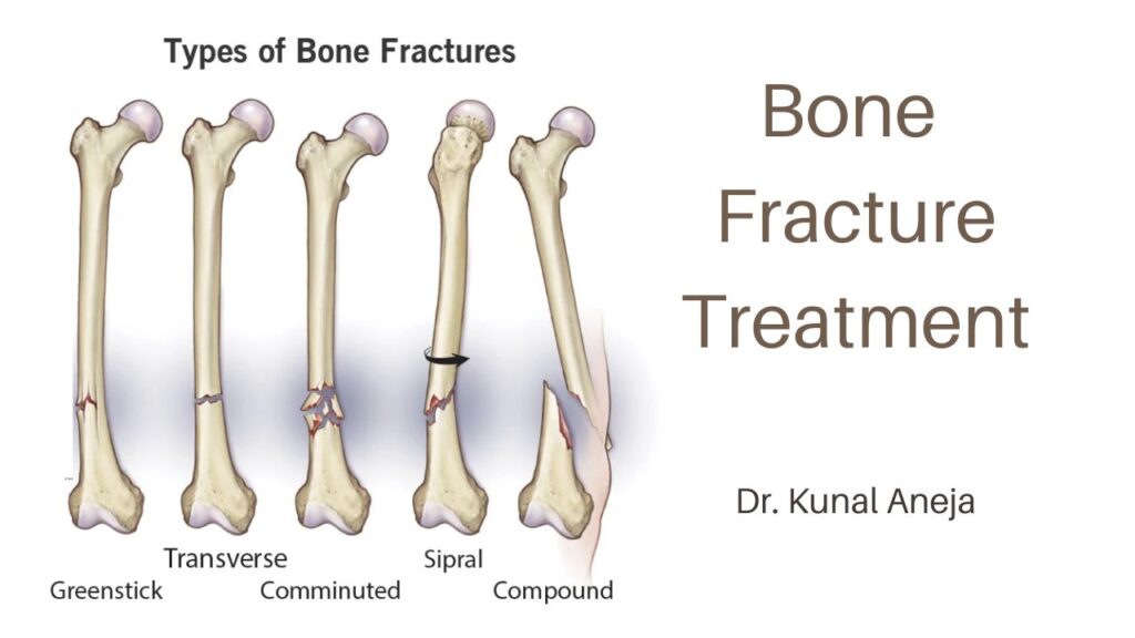 Bone Fracture Treatment Dr. Kunal Aneja