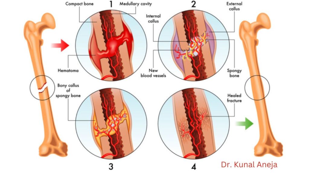 Bone Fracture Treatment in Delhi