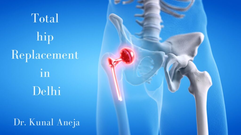 hip replacement surgery in Delhi