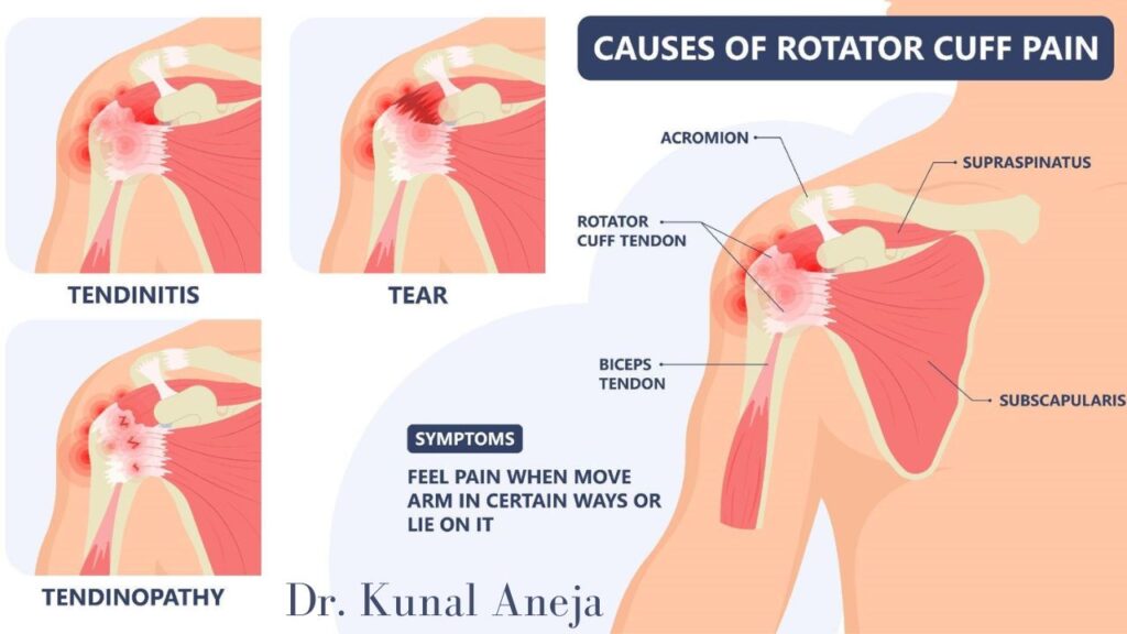 Rotator Cuff Injuries Happen