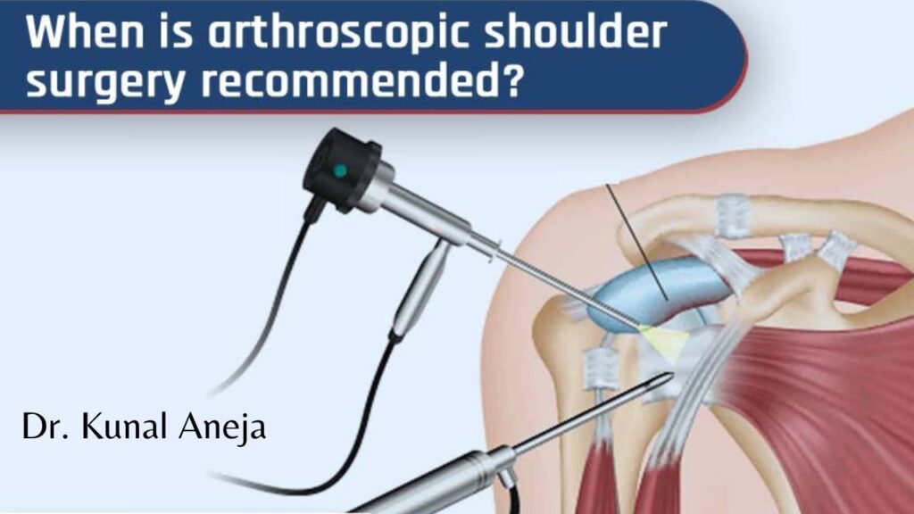 shoulder arthroscopy in delhi