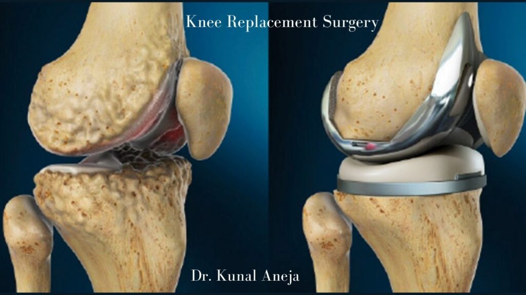 Knee Replacement surgeon in Delhi