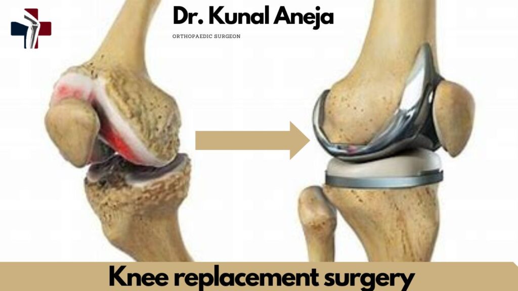 Total Knee Replacement