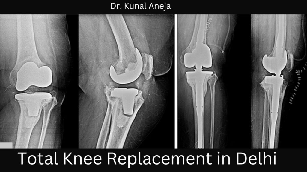Total Knee Replacement in Delhi