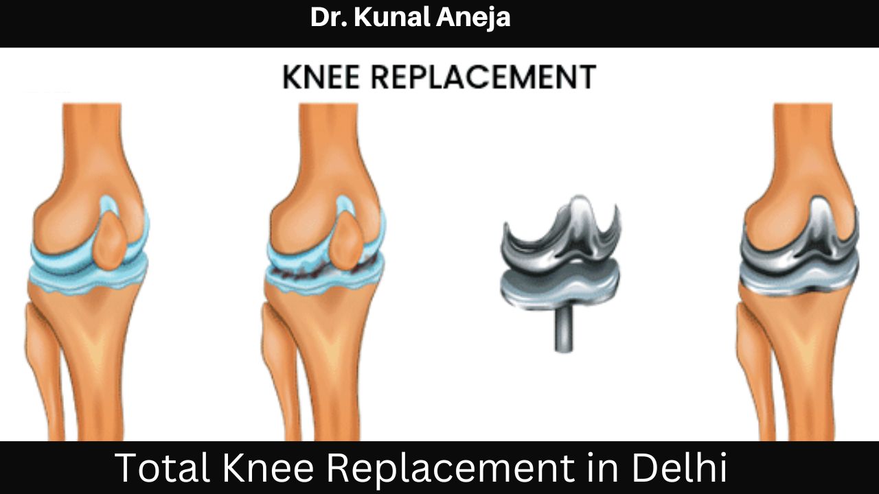 What Is Knee Replacement Surgery