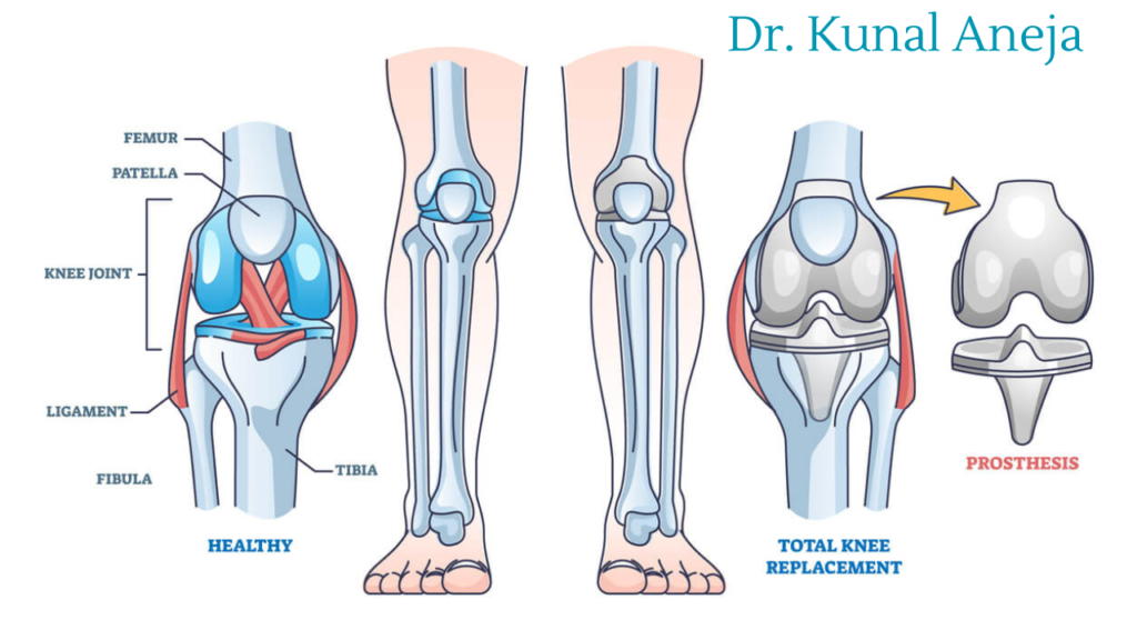 Best Knee Replacement Surgeon in Delhi