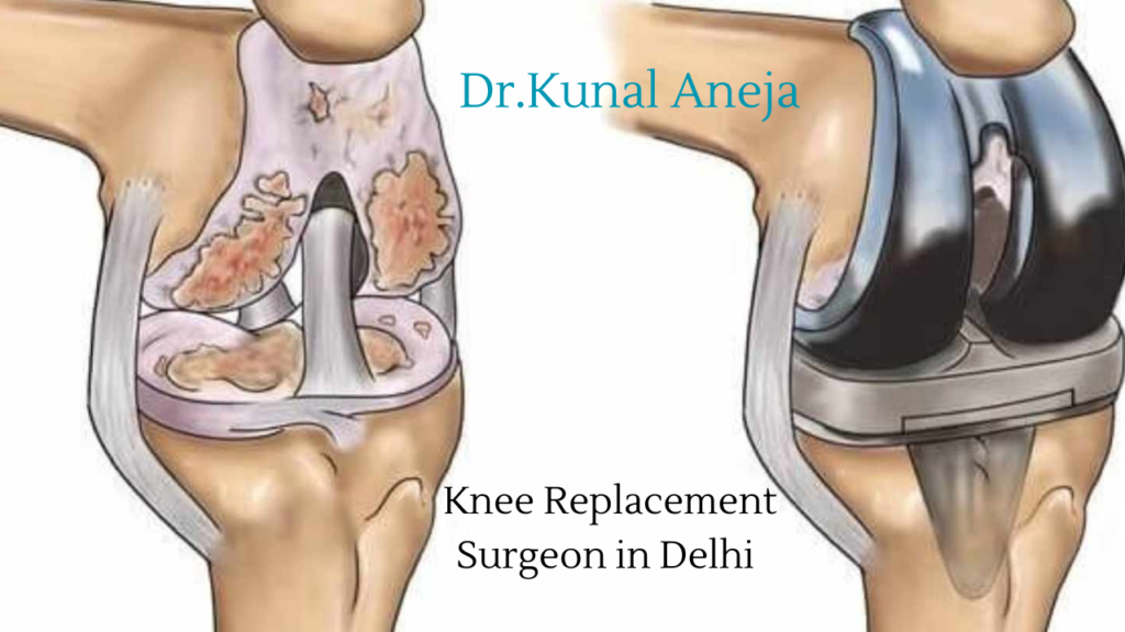 Total knee replacement in Delhi