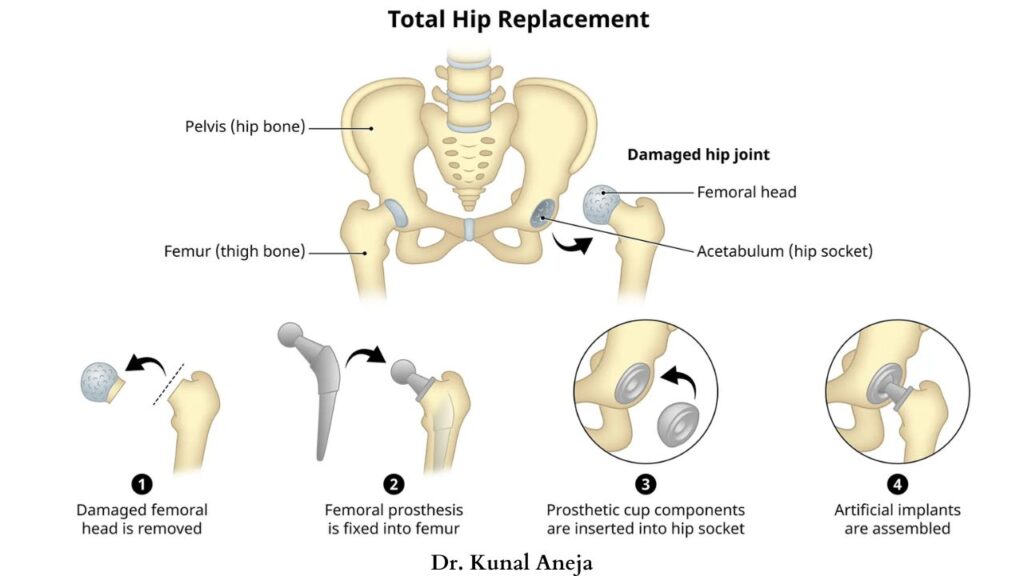 Hip Replacement Surgeon in Delhi | Dr. Kunal Aneja