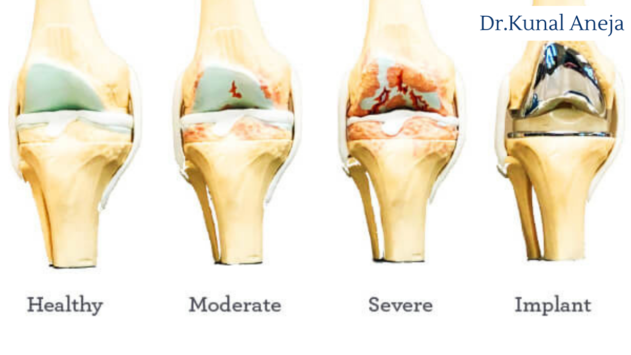 Total Knee Replacement in Delhi | Recovery
