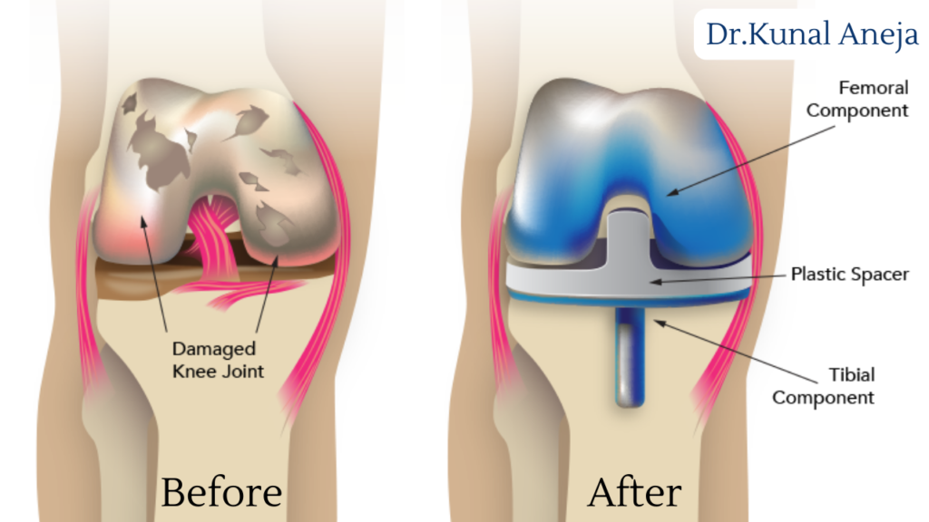 Total Knee Replacement