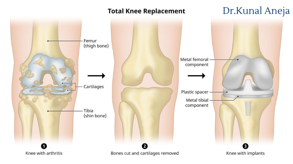 knee replacement surgeon in delhi
