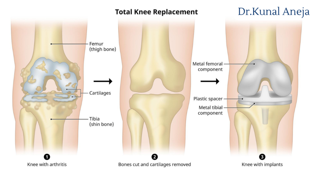 Total Knee Replacement in Delhi