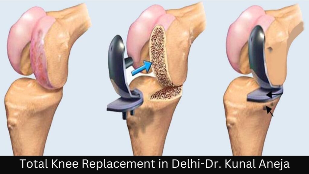 Total Knee Replacement