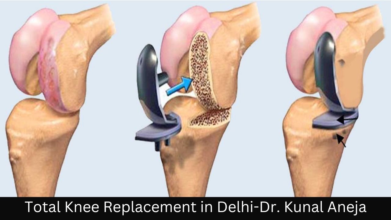 Total Knee Replacement in Delhi