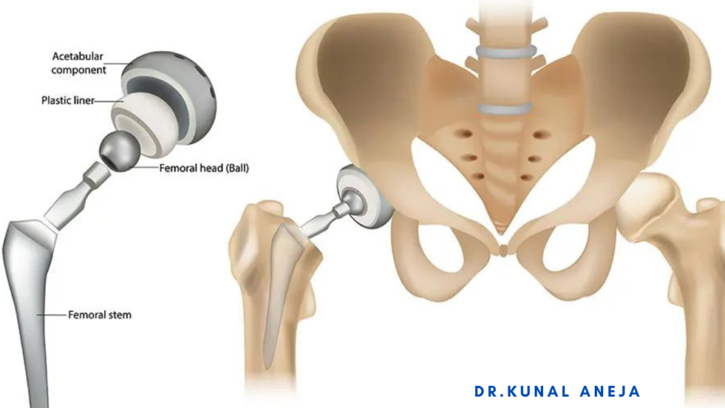 Total Hip Replacement in Delhi/NCR