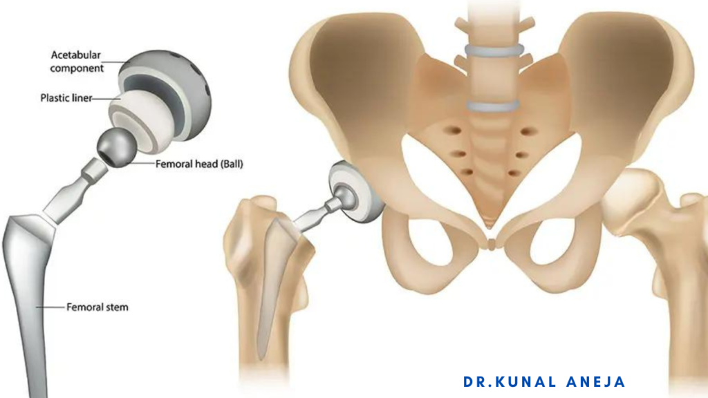 Hip Replacement Surgeon in Delhi