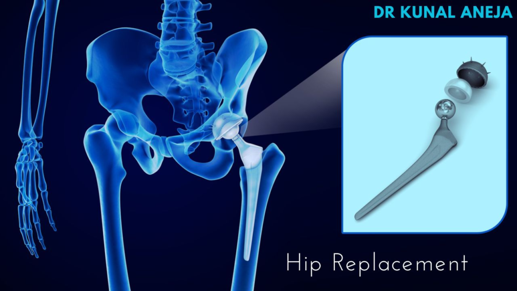Total Hip Replacement in Delhi/NCR | Dr. Kunal Aneja