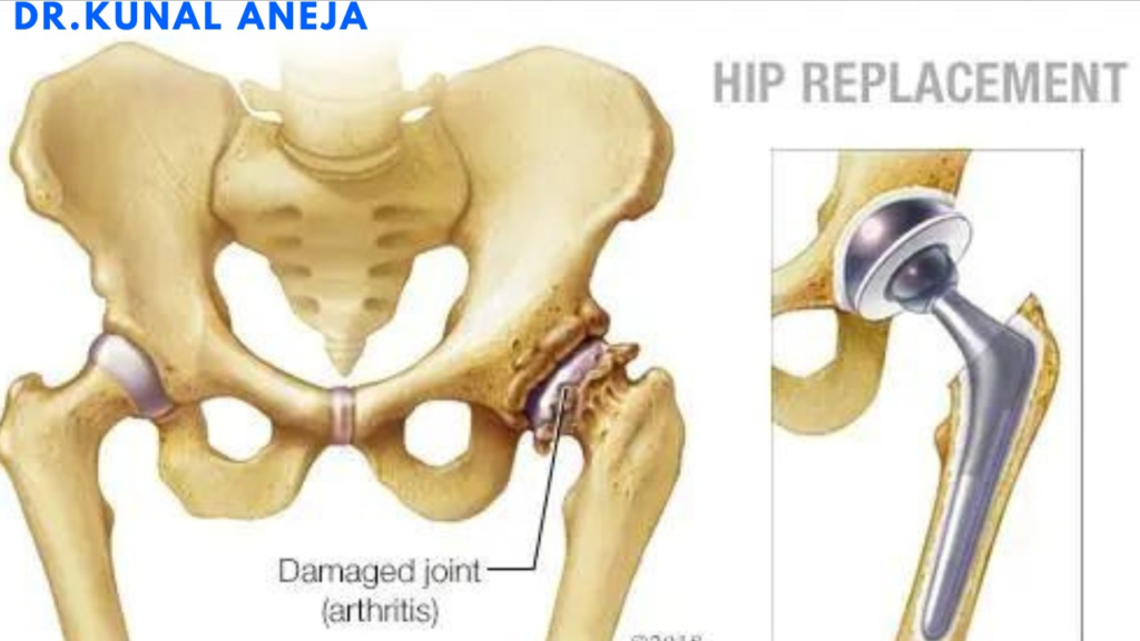 Hip Replacement Surgeon in Delhi