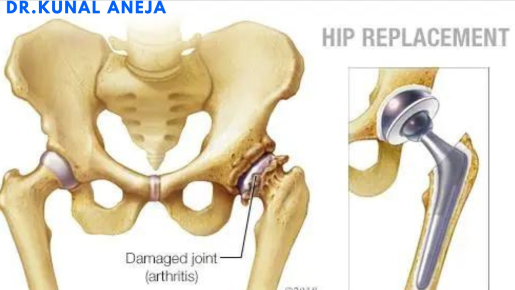 Hip Replacement 