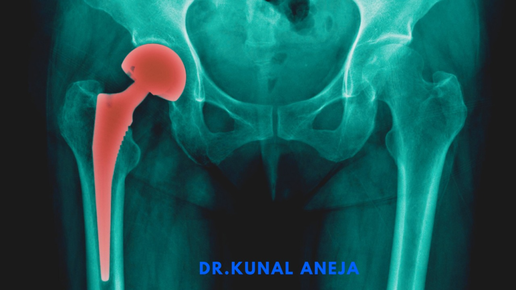 Hip Replacement 