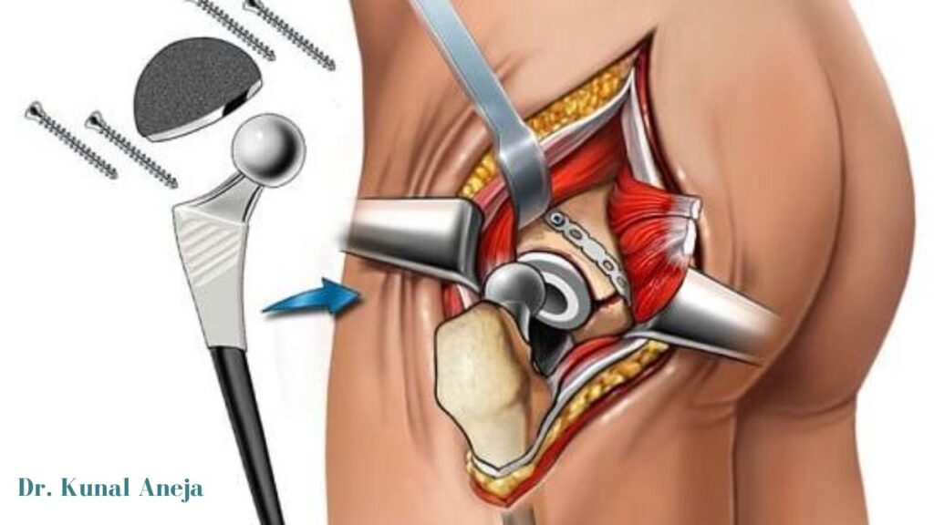 Hip Replacement in Delhi 