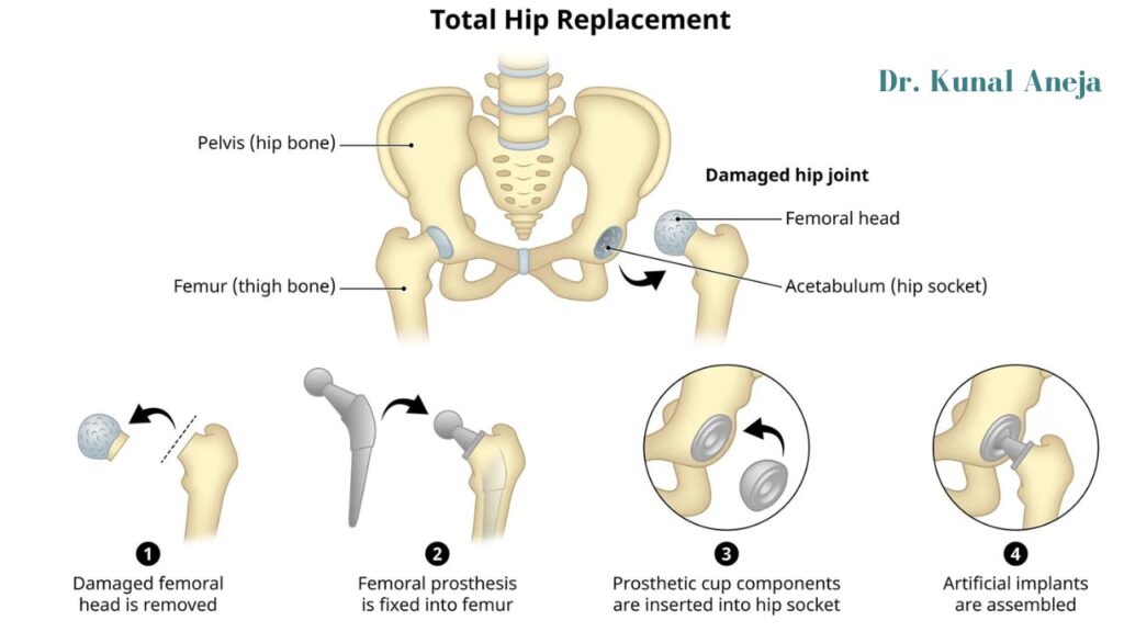 Best Hip Replacement Surgeon in Delhi / NCR - Dr. Kunal Aneja