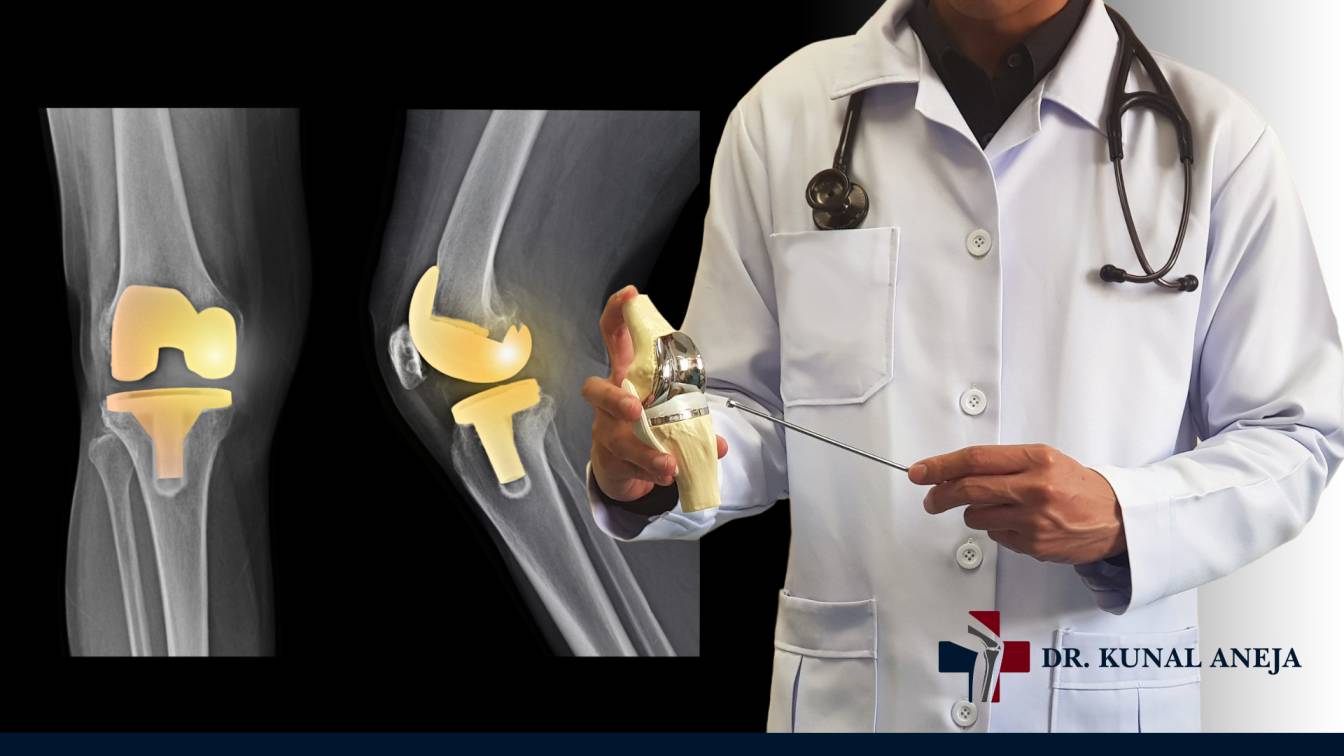 Best Orthopedic Surgeon for Knee and Hip Replacement in Delhi