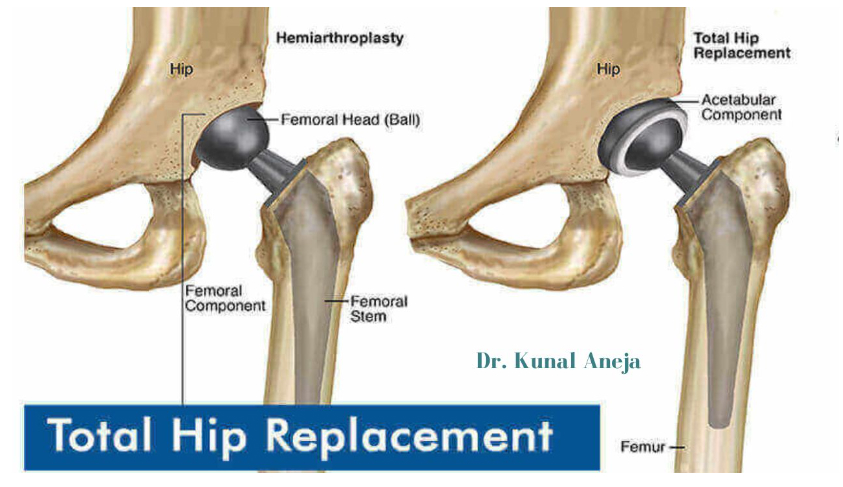 Hip Replacement Surgeon in Delhi