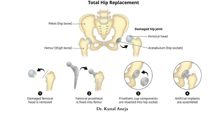 Advanced Knee & Hip Surgery by Dr Kunal Aneja in Delhi