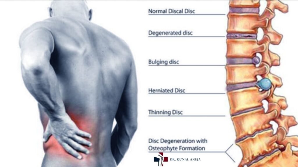Lower Back Pain Treatment in Delhi