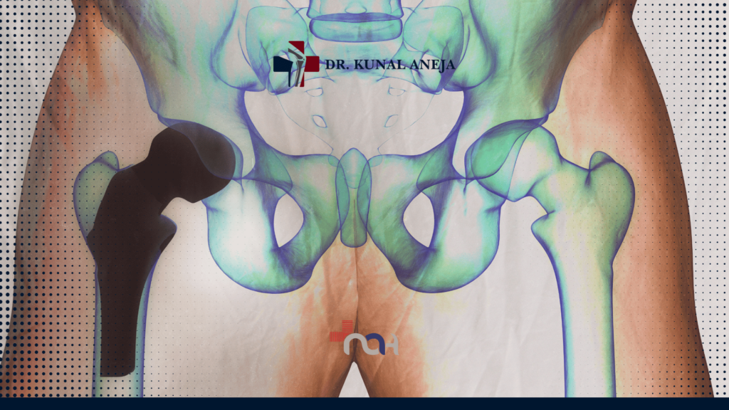 Hip Replacement in Delhi by Dr Kunal Aneja | Trusted Surgeon
