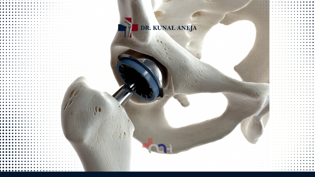Discover Top Hip Replacement Surgeon in Delhi | Unveiling Excellence