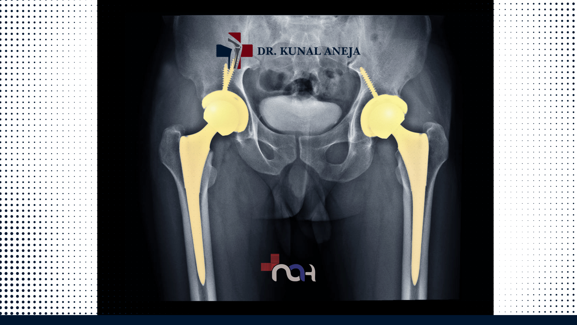 Finding The Best Hip Replacement Surgeon In Delhi 7503