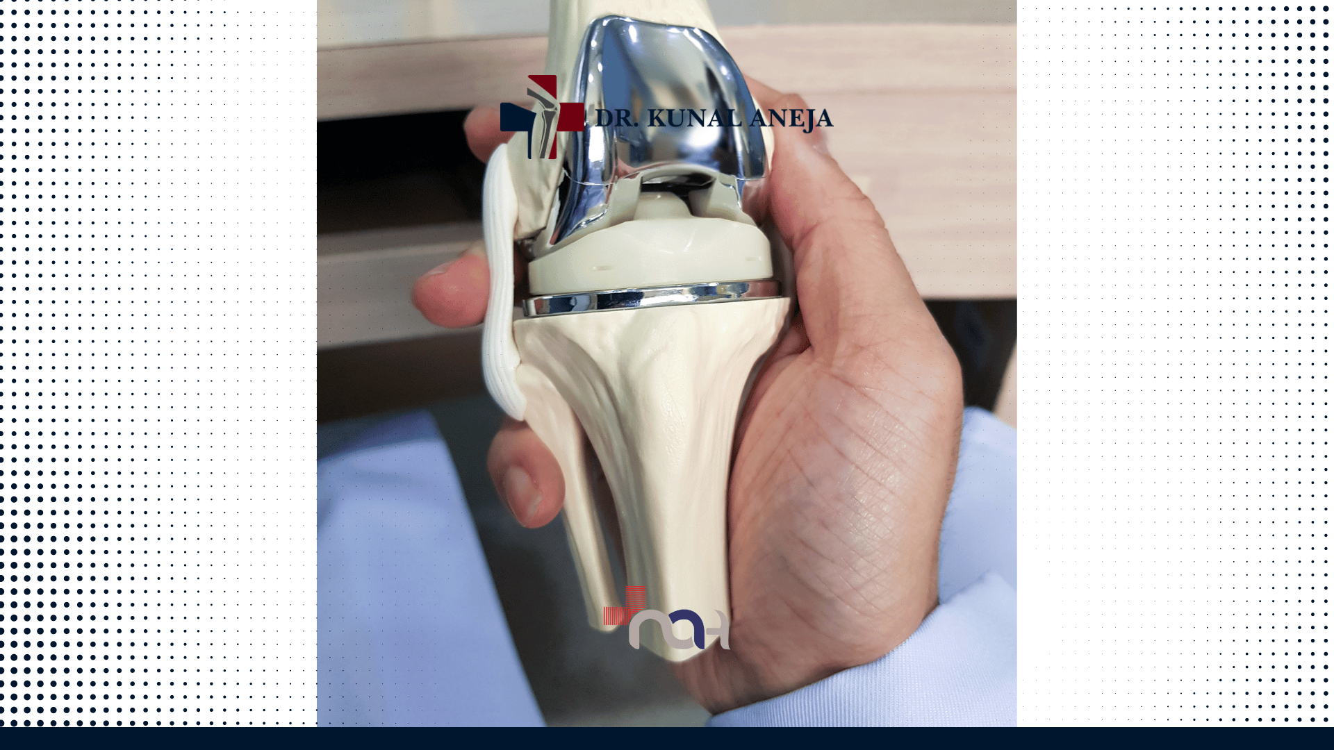Total Knee Replacement in Delhi - Expert Care for Joint Health