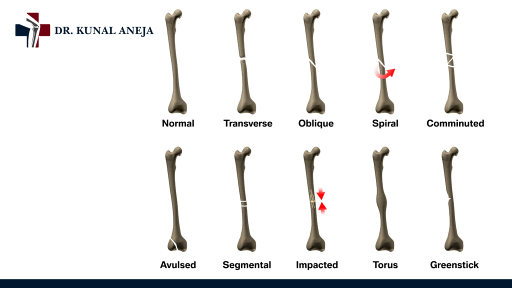 Bone Doctor in Delhi