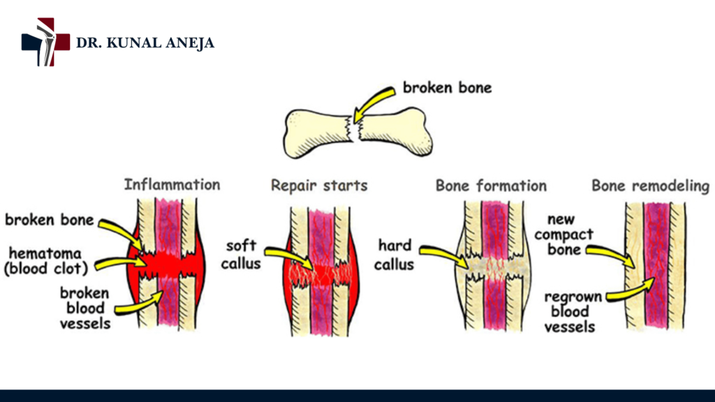 Bone Doctor in Delhi